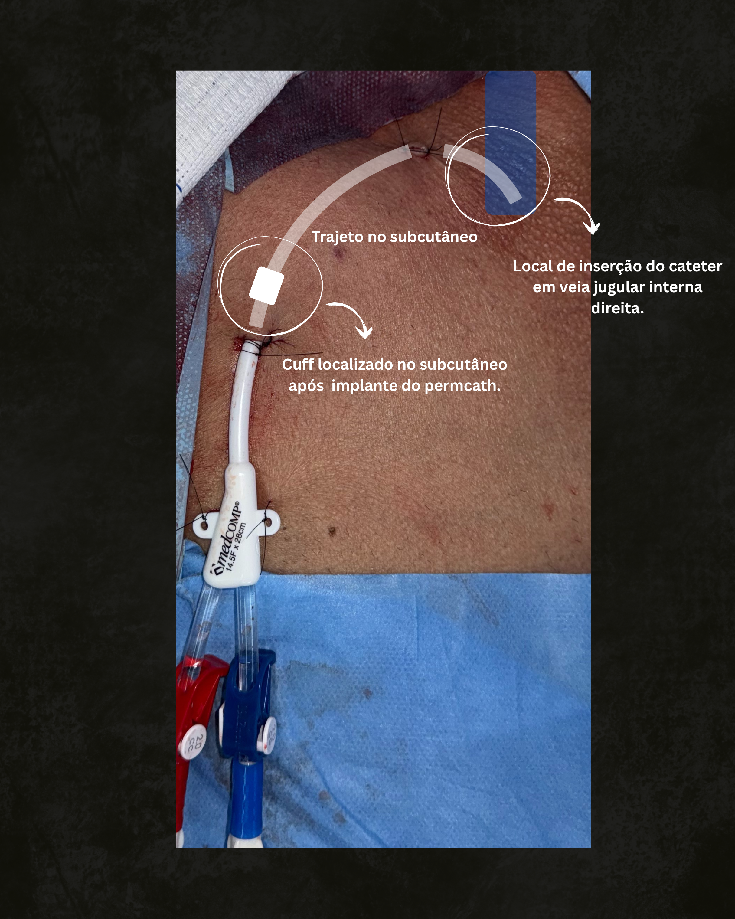 Ilustração de um permcath implantado, com parte externa visível e segmento subcutâneo com cuff